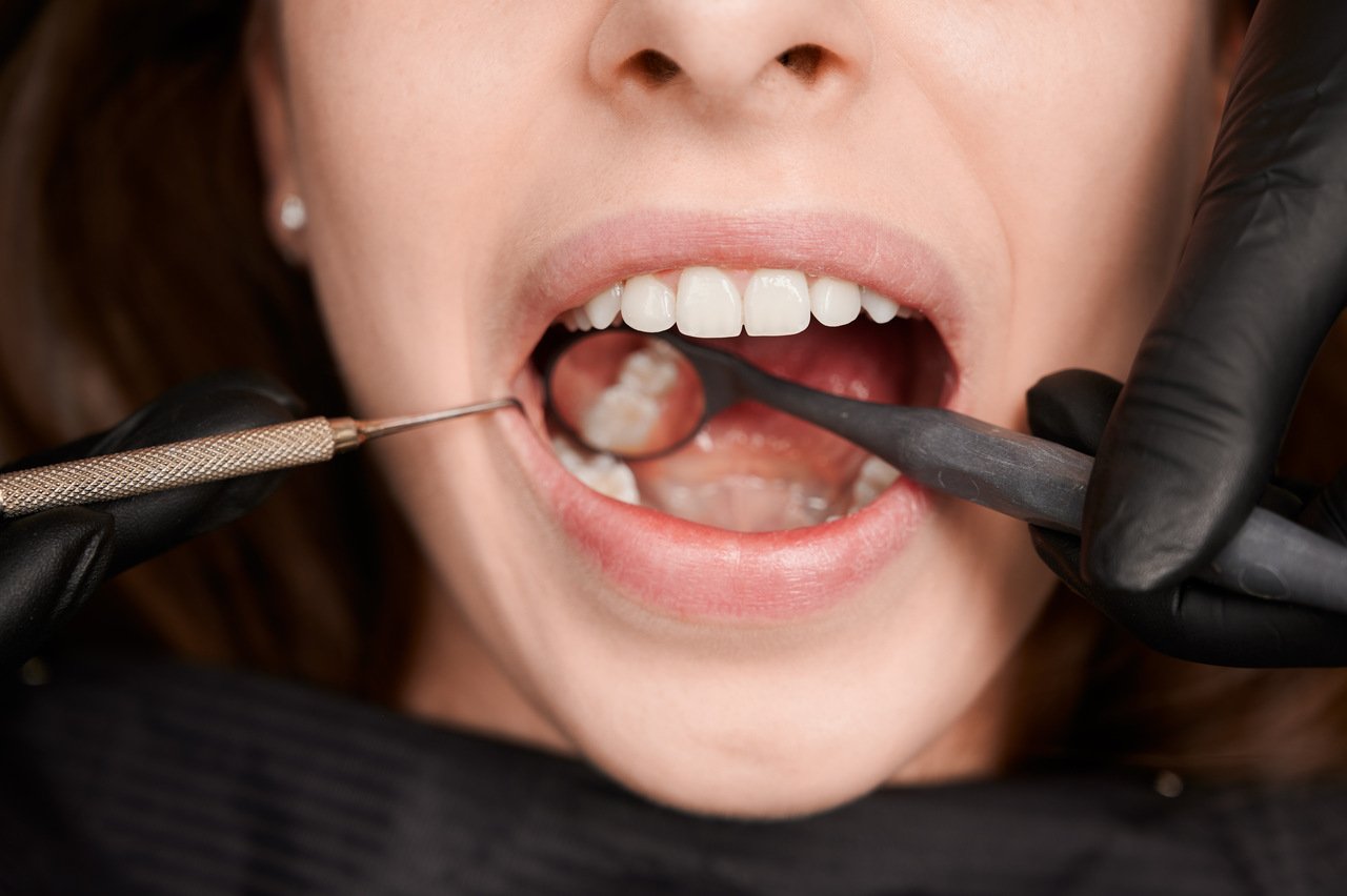 Mulher no dentista com close aproximado de um dente com cárie.